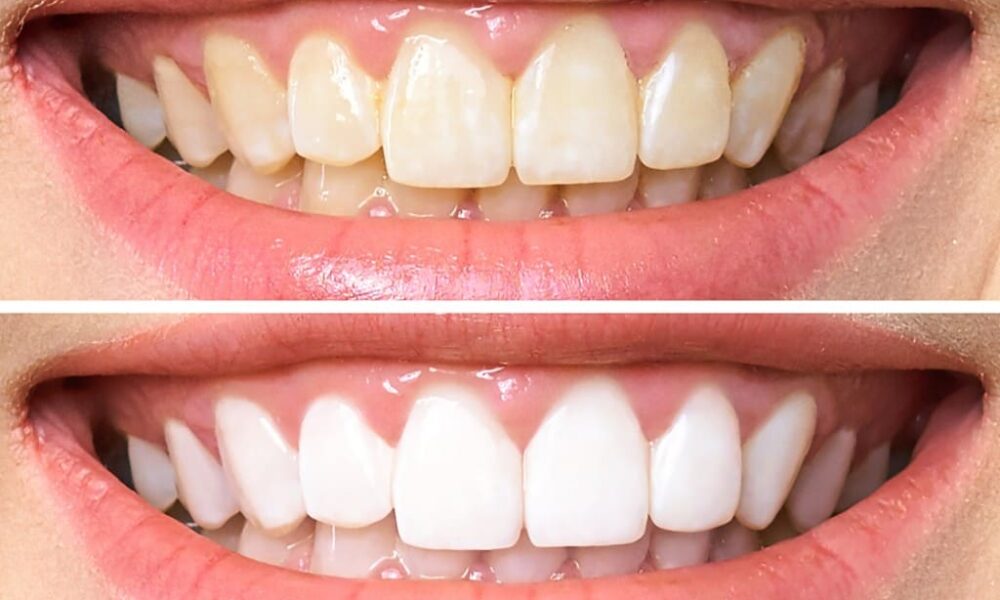 dicas de como clarear os dentes naturalmente