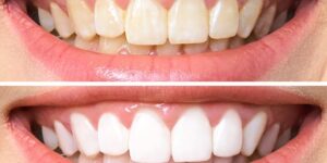 dicas de como clarear os dentes naturalmente