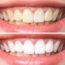 dicas de como clarear os dentes naturalmente