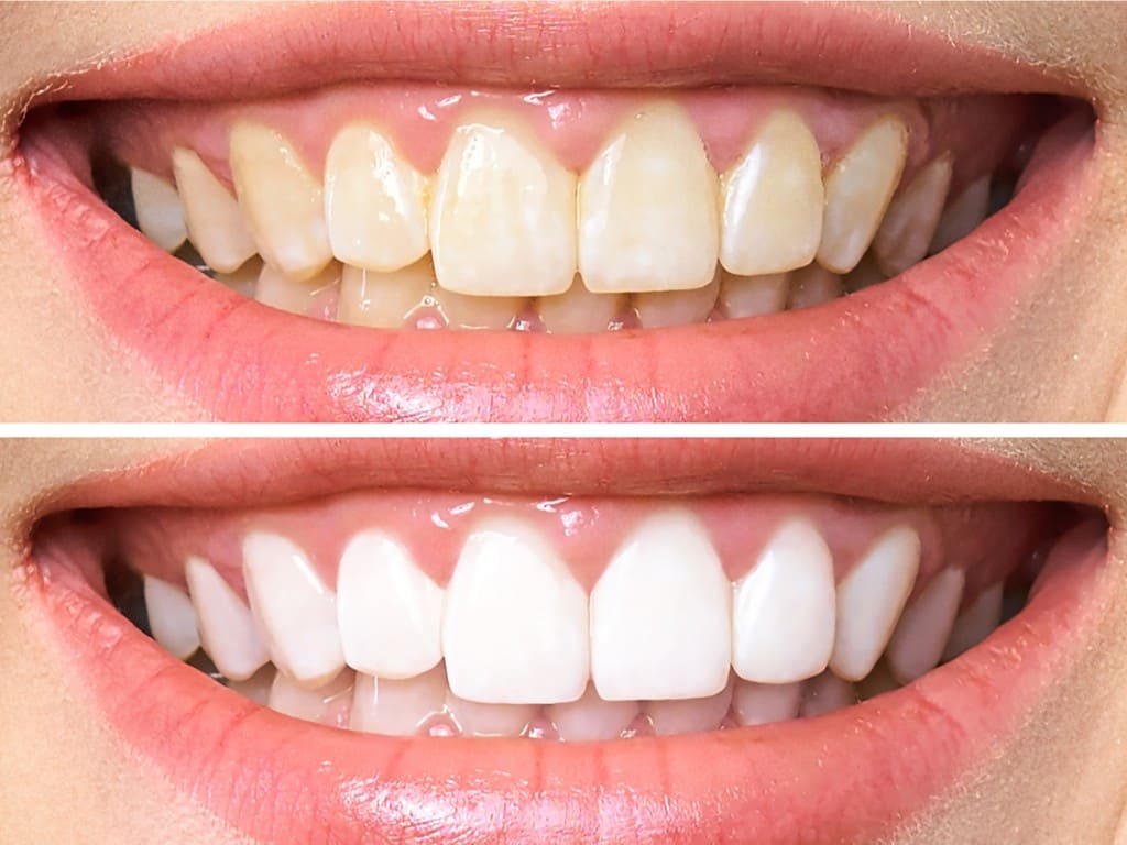 dicas de como clarear os dentes naturalmente